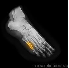 Foot-Fracture-5th-MT-38